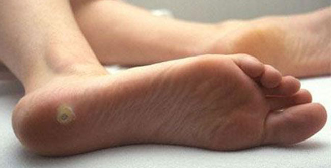Шип на ступне лечение в домашних условиях 172