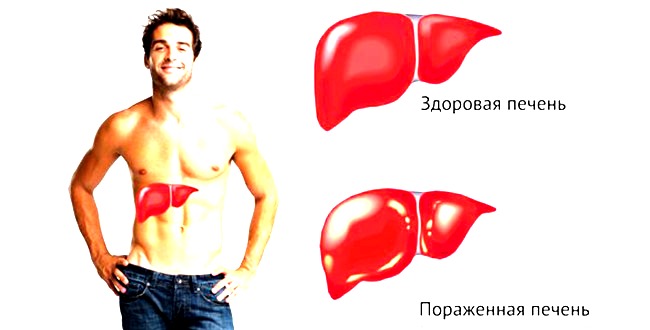 лечение печени