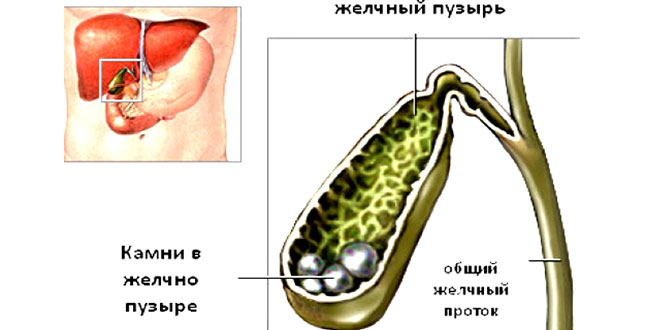 болит желчный пузырь